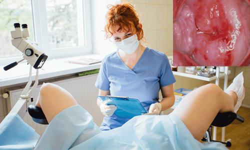 chữa viêm lộ tuyến cổ tử cung ở đâu tốt nhất