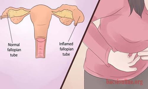 dấu hiệu của tắc vòi trứng