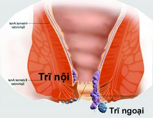 Những dấu hiệu của bệnh trĩ