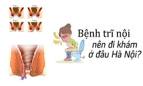 Địa chỉ chữa bệnh trĩ nội Địa chỉ chữa bệnh trĩ nội