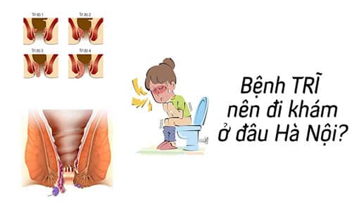 Khám trĩ ở đâu tốt? Địa chỉ khám trĩ ở Hà Nội? Khám trĩ ở đâu tốt? Địa chỉ khám trĩ ở Hà Nội?