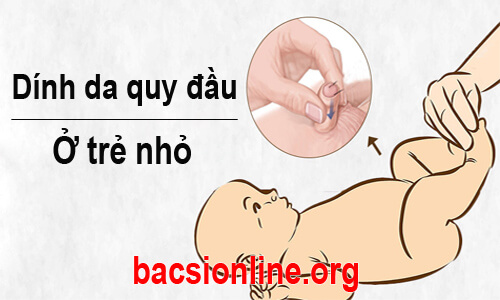Dính bao quy đầu ở trẻ nhỏ có nguy hiểm không