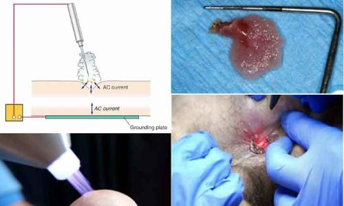 Đốt sùi mào gà có để lại sẹo không