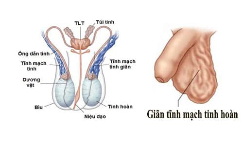 Giãn tĩnh mạch tinh hoàn gây đau tinh hoàn phải và bụng dưới Giãn tĩnh mạch tinh hoàn gây đau tinh hoàn phải và bụng dưới
