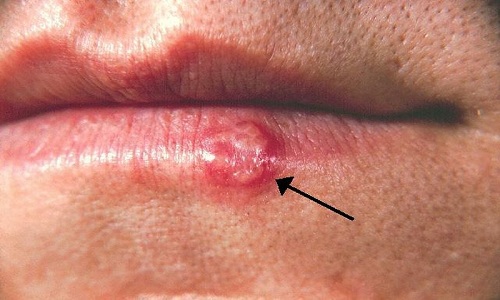 Hình ảnh herpes sinh dục ở miệng