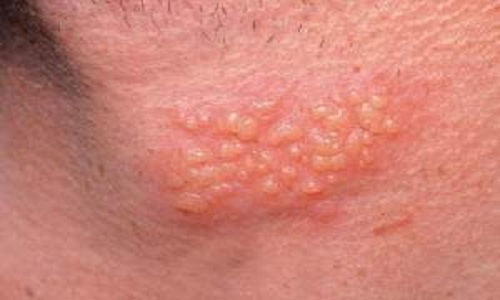 Hình ảnh mụn rộp sinh dục ở cổ