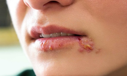 Bệnh herpes sinh dục là gì? Hình ảnh nhận biết và cách điều trị