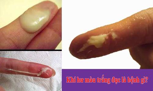 Khí hư màu trắng đục