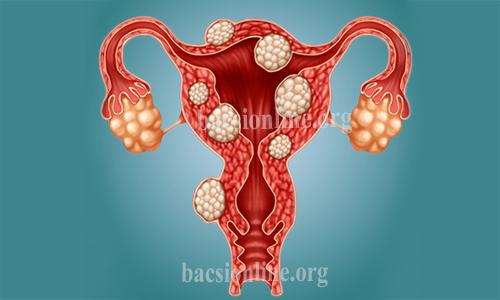 Mổ u xơ tử cung có nguy hiểm không