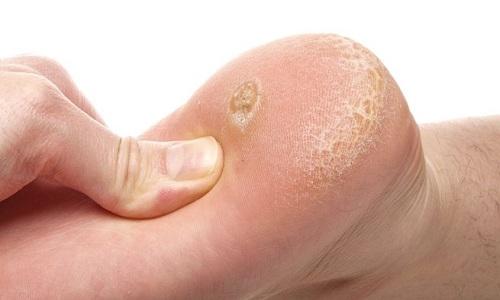 Mụn cóc ở lòng bàn chân