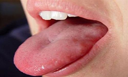 Mụn cóc sinh dục ở miệng