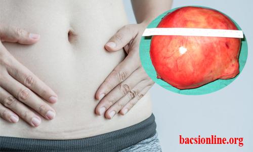 Sau khi mổ u xơ tử cung có những biến chứng gì