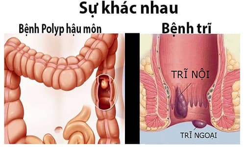 Bệnh trĩ và bệnh polyp hậu môn khác nhau thế nào? Bệnh trĩ và bệnh polyp hậu môn khác nhau thế nào?