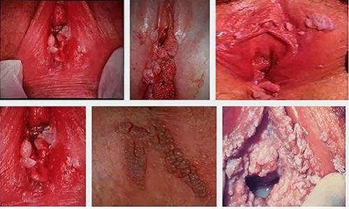 Nổi mụn thịt ở vùng kín nữ giới là biểu hiện bệnh sùi mào gà