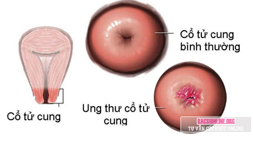Ung thư cổ tử cung có chữa được không? Ung thư cổ tử cung có chữa được không?