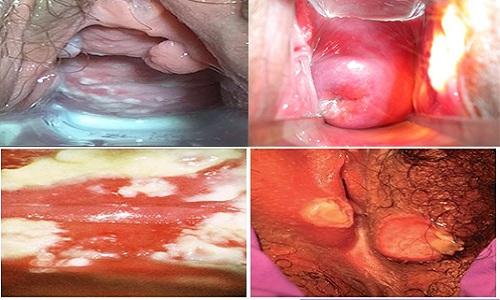 Nổi mụn thịt ở vùng kín nữ giới là biểu hiện của bệnh nhọt âm đạo