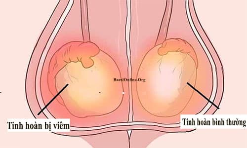 Viêm tinh hoàn gây đau tinh hoàn phải và bụng dưới Viêm tinh hoàn gây đau tinh hoàn phải và bụng dưới