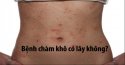 Bệnh chàm khô có lây không? Cách phòng bệnh chàm khô