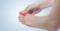 Bệnh cước là gì? Cách chữa bệnh cước vào mùa lạnh dứt điểm