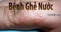 Thông tin về bệnh ghẻ nước và cách điều trị nhanh nhất 
