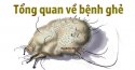 Tổng quan về bệnh ghẻ và cách chữa bệnh ghẻ nhanh nhất