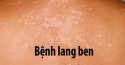 Tìm hiểu bệnh lang ben và cách chữa lang ben hiệu quả nhất