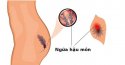 Thông tin cần biết về bệnh ngứa hậu môn