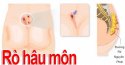 Bệnh rò hậu môn có nguy hiểm không? Triệu chứng của bệnh rò hậu môn
