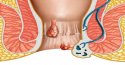 Tìm hiểu về bệnh trĩ, những tác hại của bệnh trĩ