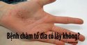 Bệnh chàm tổ đỉa có lây không? Có nguy hiểm đến sức khỏe không?