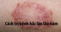 Bệnh hắc lào lâu năm có chữa khỏi được không?