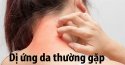 Những loại dị ứng da thường gặp và cách chữa hiệu quả