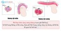 Rối loạn cương dương là gì? Cách chữa rối loạn cương dương?