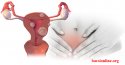 7 triệu chứng của bệnh u xơ cổ tử cung điển hình nhất