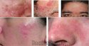 Xóa tan nỗi lo viêm da dầu ở mặt với cách chữa sau đây