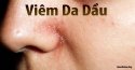 Viêm da dầu là gì? Viêm da dầu có chữa khỏi không?
