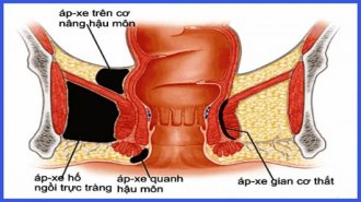 Tìm hiểu về bệnh apxe hậu môn