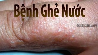 Thông tin về bệnh ghẻ nước và cách điều trị nhanh nhất 