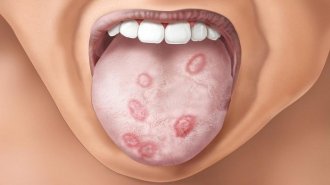 Nguy hiểm khôn lường khi phải mắc giang mai ở miệng