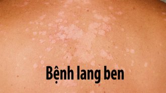 Tìm hiểu bệnh lang ben và cách chữa lang ben hiệu quả nhất