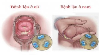 Bệnh lậu là gì? Tác hại của bệnh lậu