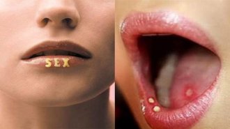 Quan hệ bằng miệng có lây bệnh lậu được không?