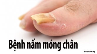 Phát hiện bệnh nấm móng chân và cách chữa trị kịp thời