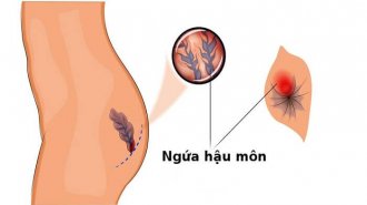 Thông tin cần biết về bệnh ngứa hậu môn