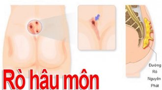 Bệnh rò hậu môn có nguy hiểm không? Triệu chứng của bệnh rò hậu môn