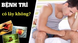 Bệnh trĩ có lây không? Cách phòng ngừa bệnh trĩ hiệu quả