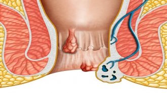 Tìm hiểu về bệnh trĩ, những tác hại của bệnh trĩ
