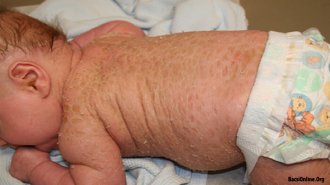 Bệnh vảy cá là gì? Bệnh vảy cá có chữa khỏi được không?