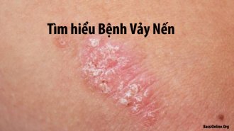 Bệnh vảy nến là gì? Triệu chứng và cách chữa vảy nến hiệu quả