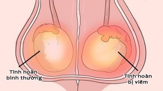 Viêm tinh hoàn có chữa được không? Phác đồ điều trị viêm tinh hoàn